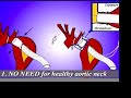 Expandable prosthesis for sutureless aortic anastomosis Expandable prosthesis for sutureless aortic anastomosis