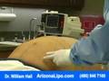 Liposuction Procedure with Dr. William Hall - Abdomen Waist
