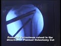 Operative Video - Fixator Assisted HTO - Part 2