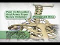  Artificial Cervical disc Replacement 