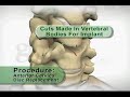 Artificial Cervical disc Replacement Artificial Cervical disc Replacement