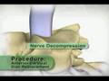 Artificial Cervical disc Replacement
