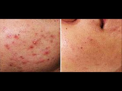 how to get rid of acne yahoo