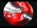 Pseudocapsule Excision Pseudocapsule Excision