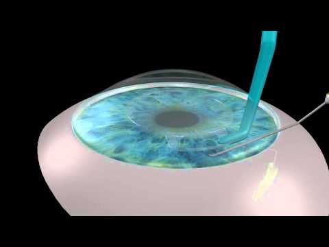 Needle enclavation of the ARTIFLEX PIOL 