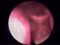 endoscopia