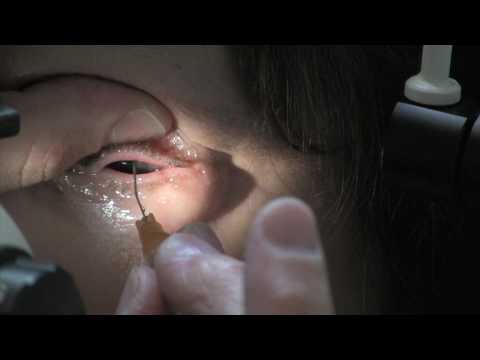 how to unclog meibomian gland