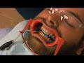 Getting Braces pt. 2 (Time Lapsed) - Bottom Brackets Getting Braces pt. 2 (Time Lapsed) - Bottom Brackets