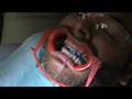Getting Braces pt. 2 (Time Lapsed) - Bottom Brackets