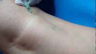 SCLEROTHERAPY: VEIN BUSTER