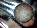 Removing Blackheads Under High Magnification Part 2