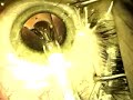 Phakic Lens ICL Injection STAAR Vision FDA Approved
