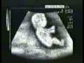 videos de Driving Fetus