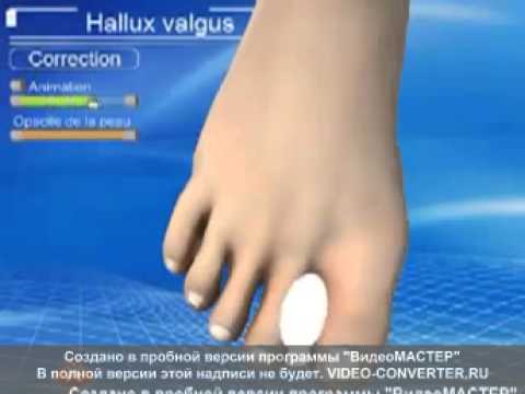 Моче недержание мочи после операции простаты