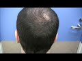 Hair Transplant Before / After - London Lad - Hasson & Wong Hair Transplant Before / After - London Lad - Hasson & Wong