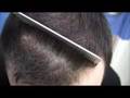 Hair Transplant Before / After - London Lad - Hasson & Wong