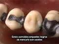 Dientes humo = Gas venenoso Smoking Teeth