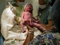 Surrogate triplet birth