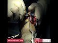 LPT Hemi Titanium Joint Replacement LPT Hemi Titanium Joint Replacement