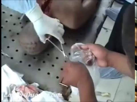 AUTOPSIA - http://lovelydisgrace.com/ Jovem de 17 anos de idade, brutalmente espancado por pelo menos 8 pessoas após se involver em um acidente de transito com sua scoo...