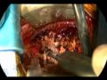 System of High Definition Exoscope in Microneurosurgery - Initial Clinical Experience