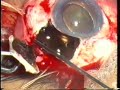 Full thickness eye wall resection Full thickness eye wall resection