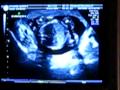 20 Week Ultrasound with the Turnip
