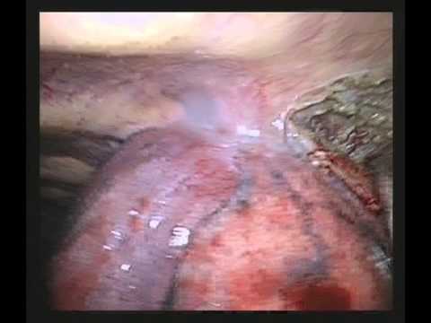 VATS Lobectomy Lower Lobe-Chest Wall Resection