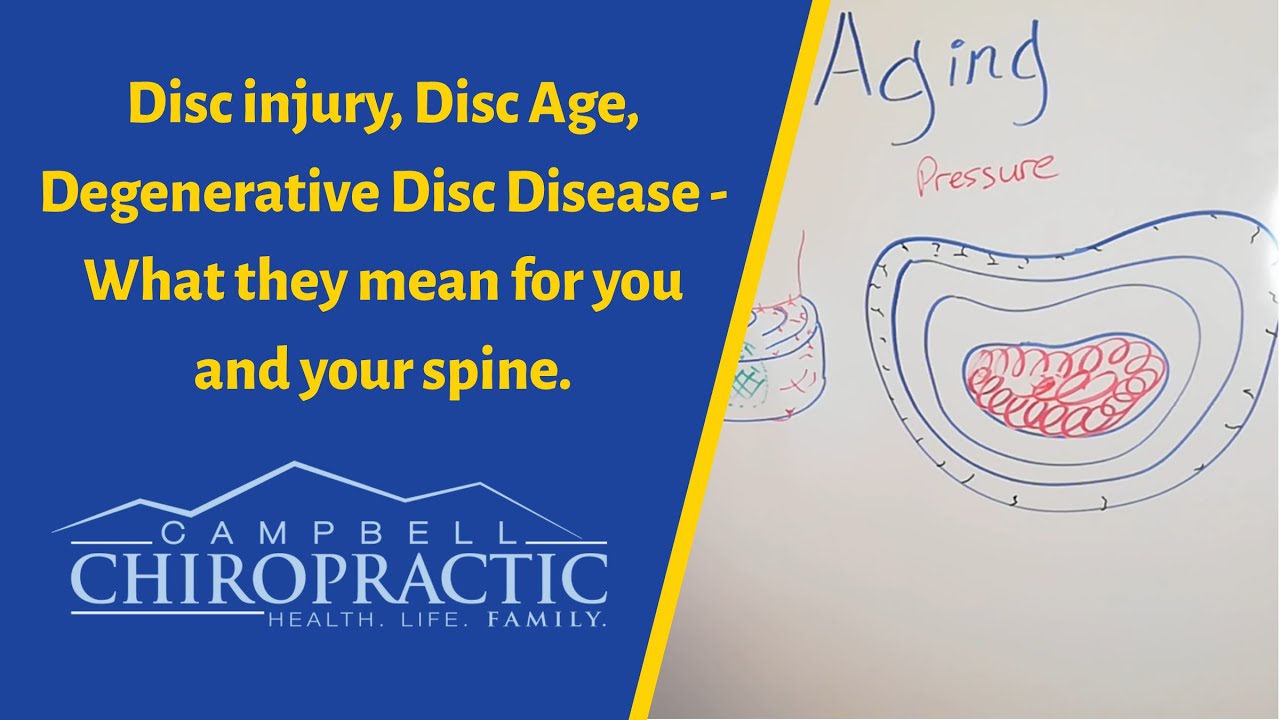 Disc injury, Disc Age, Degenerative Disc Disease - What they mean for you and your spine.