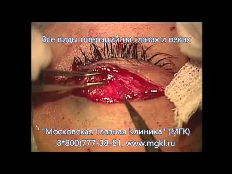 Видео Грыжи век и их лечение