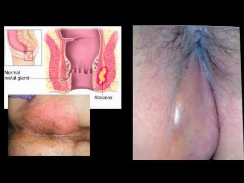 PERIANAL ABSCESS - Dr. Carlo Oller, emergency physician, talks about Perirectal Abscess.