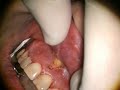 Diode Labial Frenectomy Diode Labial Frenectomy