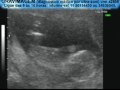 GRAVIMAGEM 952 (ULTRA-SOM  GRAVIDEZ 13  SEMANAS)