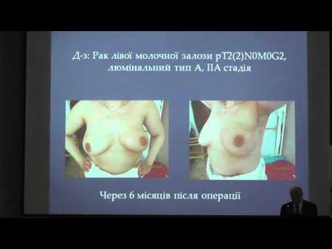 Доклад хирурга городской больницы № 9 города Днепродзержинска Юрия Гридасова «Перфорантный лоскут типа пропеллер в закрытии дефекта  грудной стенки после удаления местного рецидива опухоли молочной железы». Украина.
