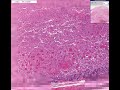 Histopathology Pituitary--Partial infarct Histopathology Pituitary--Partial infarct