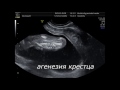 Нажмите для просмотра : Сиреномилия - синдром русалки