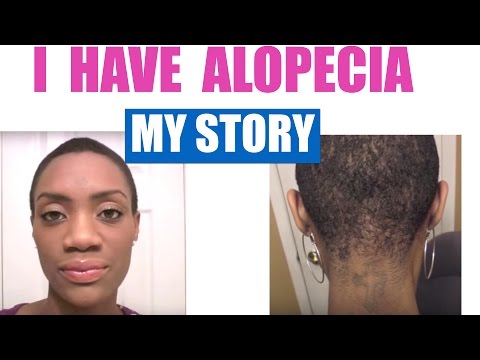 how to treat alopecia
