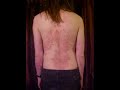 Gross Skin Rashes - Skin Rash Type