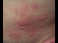 Gross Skin Rashes - Skin Rash Type