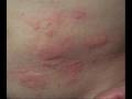 symptoms persistent skin rashes or flaky skin, pictures of different types of skin rashes,