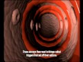 What is asthma.wmv