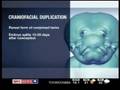 Two Faced Baby / Lali Was Born With Craniofacial Duplication