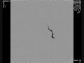 Angiogram shows a large left occipital lobe AVM. Image shows glue being injected through microcatheter into the AVM. After Embolization the injected material is seen casting the treated portions of the AVM.