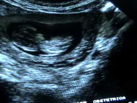 how to measure nt in ultrasound