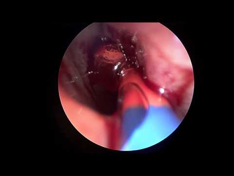 how to drain maxillary sinus