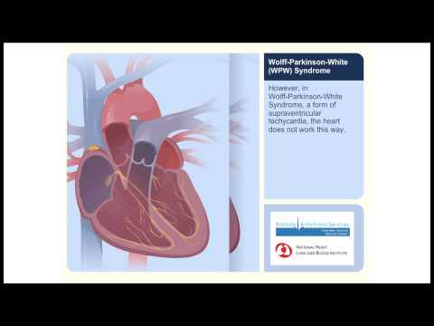 how to cure wpw syndrome