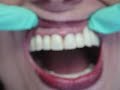 Loose Teeth Repair/ Failing Implants