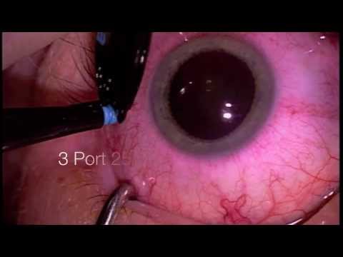 how to cure floaters