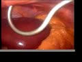 Laparoscopic Roux en Y Gastric Bypass