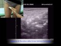 Stripping Fantasma - varici vene varicose chiva laser scleromousse, veneinforma